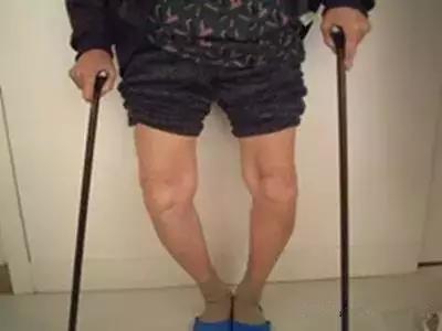 平地走路不疼上下楼痛,走路不痛上下楼痛如何治疗