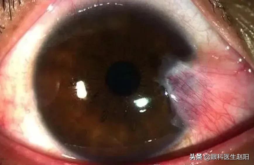 白内障引起后发障怎么办,白内障跟胬肉可以一次解决吗