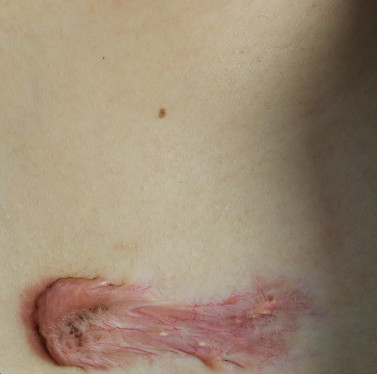 疤痕体质用什么方法祛疤好,欣奕除疤凝胶对疤痕体质有效果吗