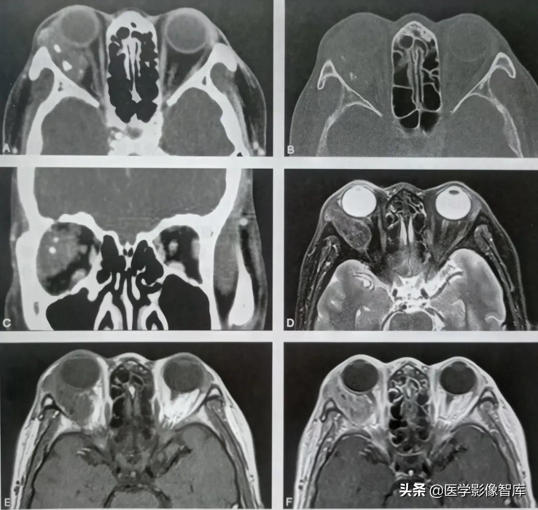 肝淀粉样变性影像,肾淀粉样变性诊断标准
