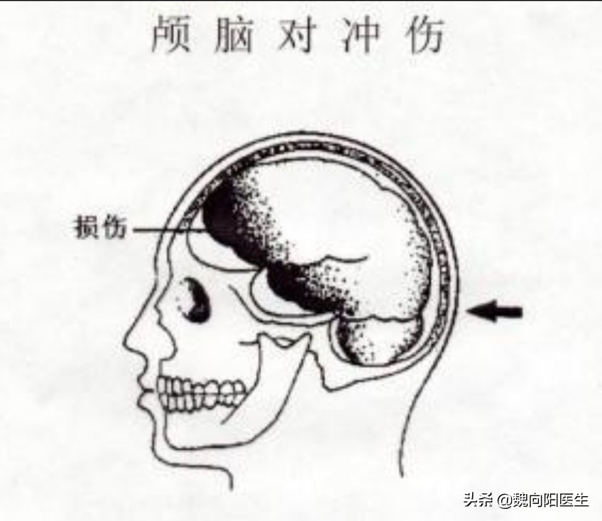 为什么后脑勺怕风,后脑勺着地好不好