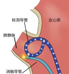 房颤的射频消融,房颤的射频消融从什么血管进入