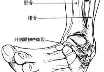 踝关节扭伤针灸视频教程,踝关节扭伤针灸处方