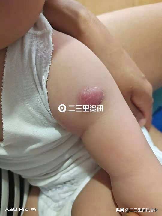 小孩接种卡介苗很久红肿,宝宝接种卡介苗后红肿化脓