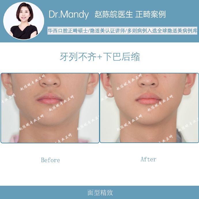 杭州牙齿隐形矫正,杭州成人隐形矫正牙齿优惠