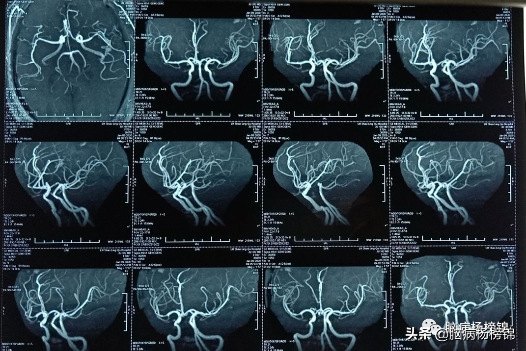 脑出血和脑梗塞同时出现已经昏迷,急性脑梗塞和急性脑出血同时出现