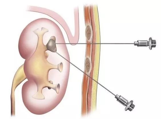 如果得了结石病你要注意哪些,结石感觉快要发作了怎么缓解