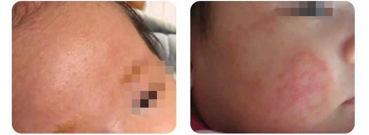 湿疹的预防与护理,湿疹护理及预防