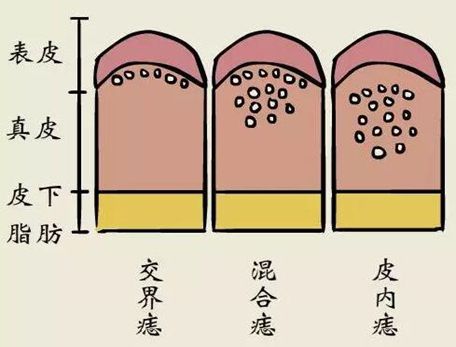祛了黑痣几年后还有痣怎么办,从小就有黑痣要不要祛除