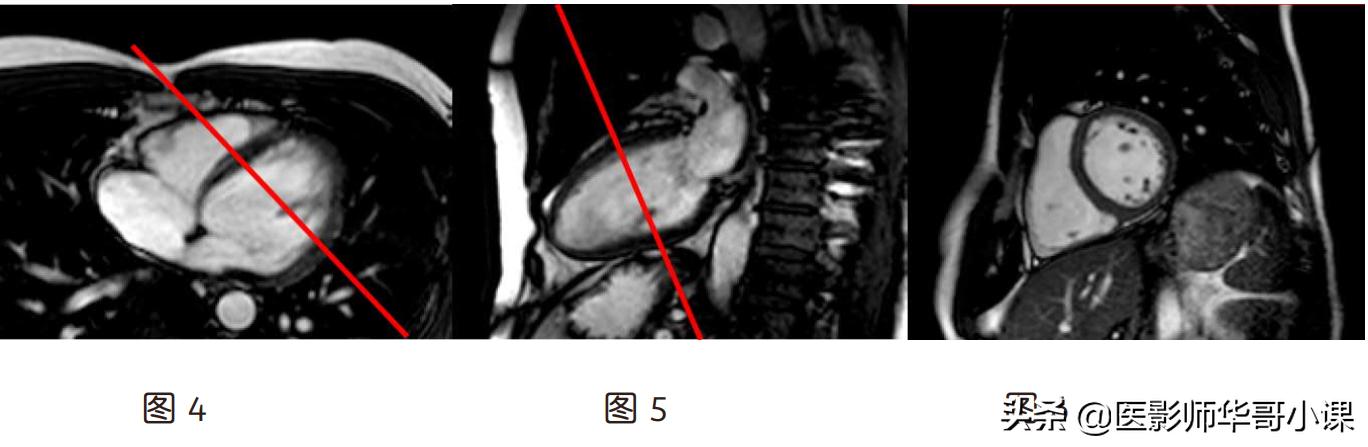 磁共振心脏扫描标准切面,心脏mri扫描定位