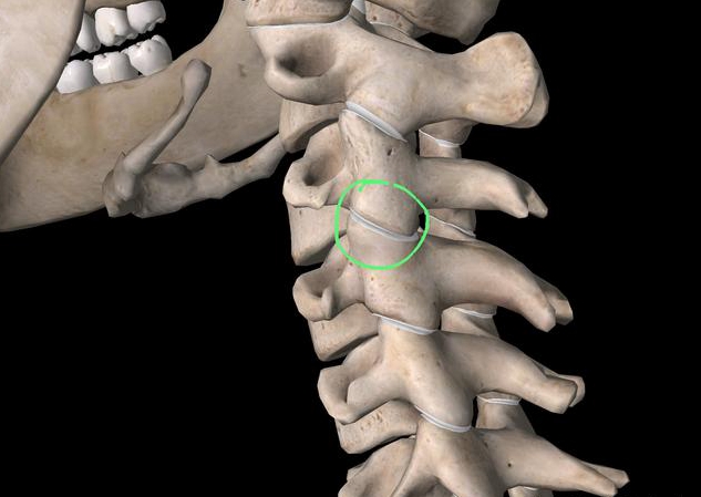 c5-6椎间盘突出是大手术吗,颈椎c5c6椎间盘突出手麻怎么办
