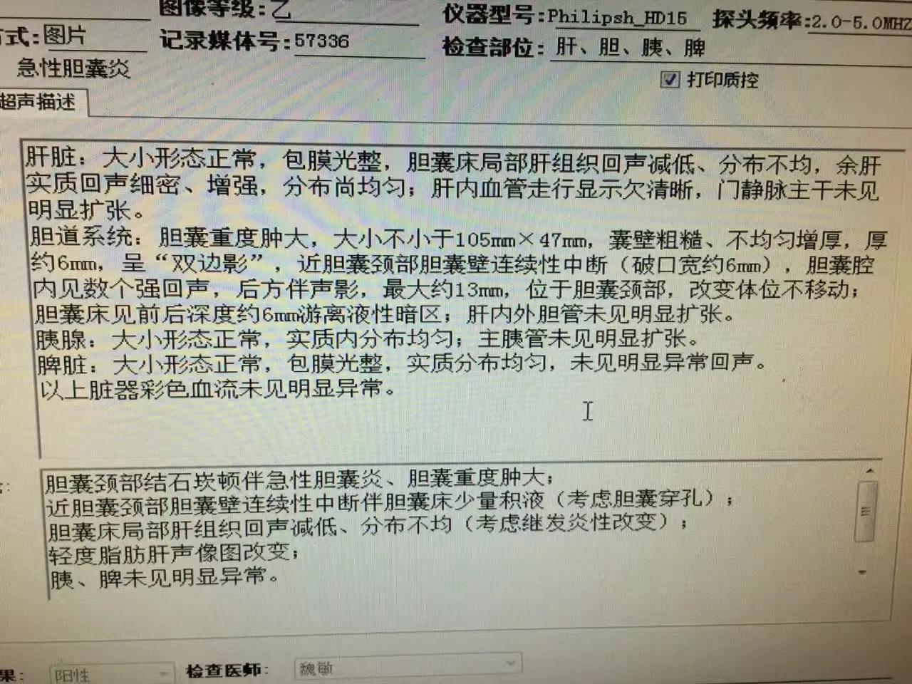 一公分胆结石并且引发急性胆囊炎,一颗胆结石必须摘胆吗