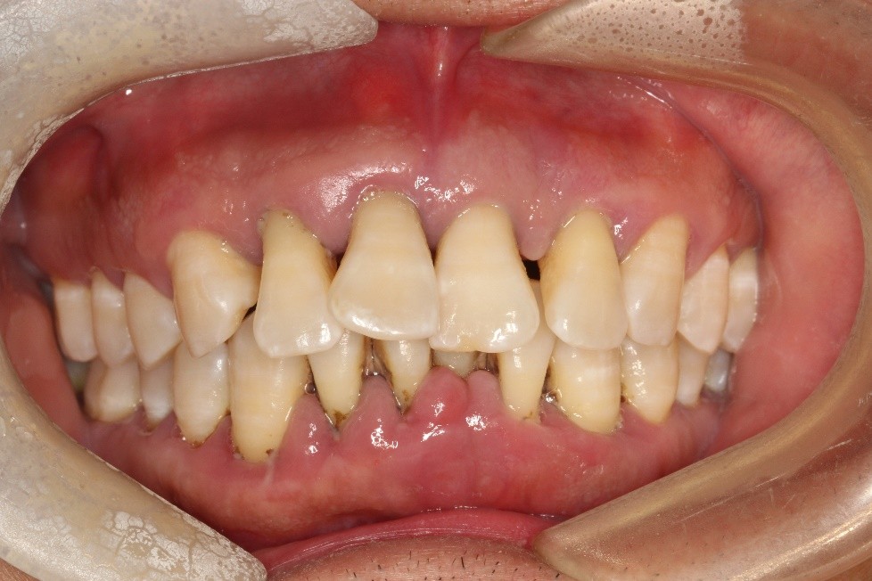 成人矫正期间牙齿松动正常吗,成年人牙齿矫正会松动吗