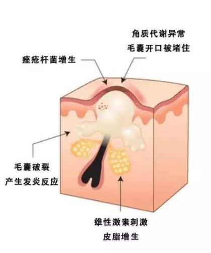 丘疹性痘痘肌肤怎么治疗,如何彻底根治丘疹型痘痘