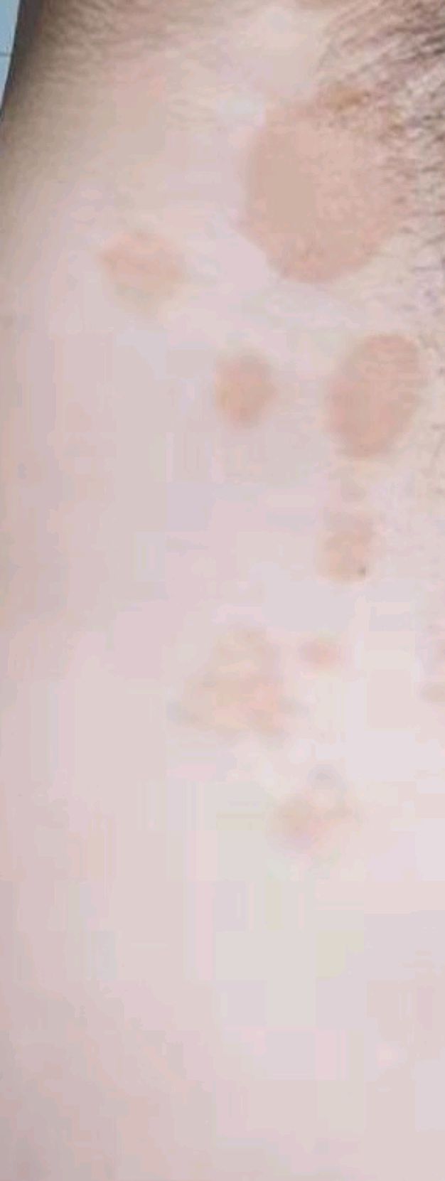 什么是汗斑呢如何正确治疗汗斑,汗斑怎么治能根除吗