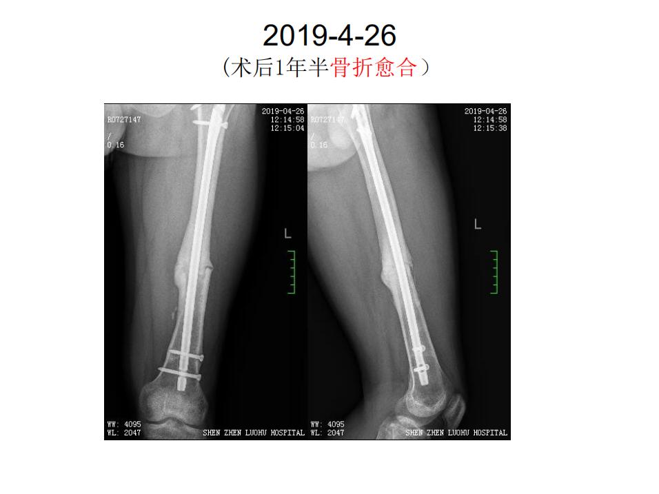 平乐骨科推拿教学,中医治疗骨折畸形愈合