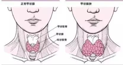 甲亢自我诊疗与全面调养的区别,甲亢防止复发