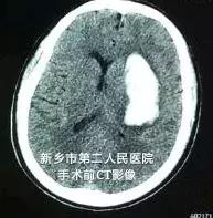 脑出血偏瘫的针灸治疗,脑出血能彻底治好吗