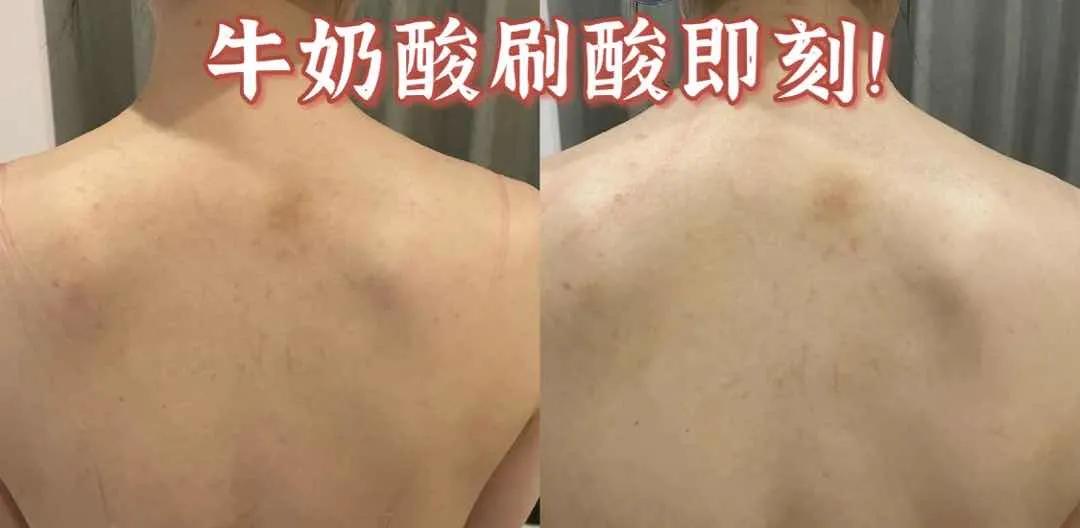 夏天露肉的季节,露肉的正确美白方法