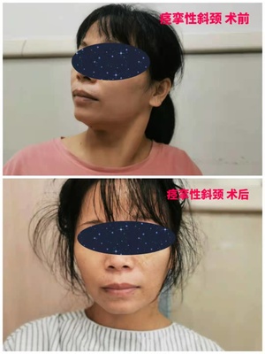 落枕后脖子抬不起来怎么办,落枕了头转不过去怎么办