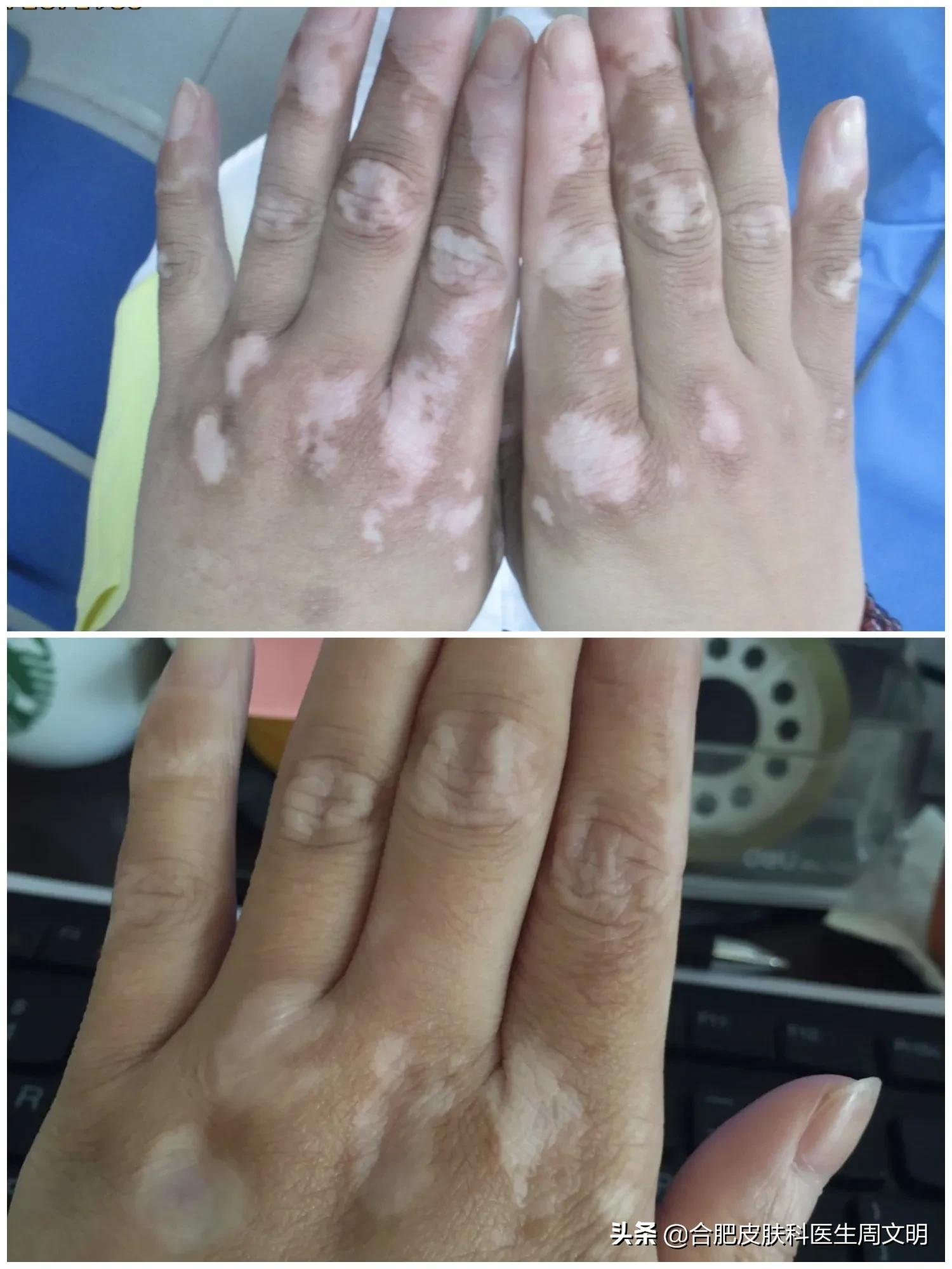 白癜风白斑变好的治疗方法,20年的白癜风自愈的最快方法