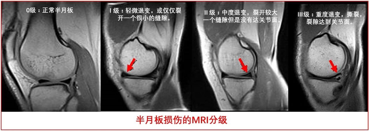 善待你的半月板,善待膝关节珍惜半月板