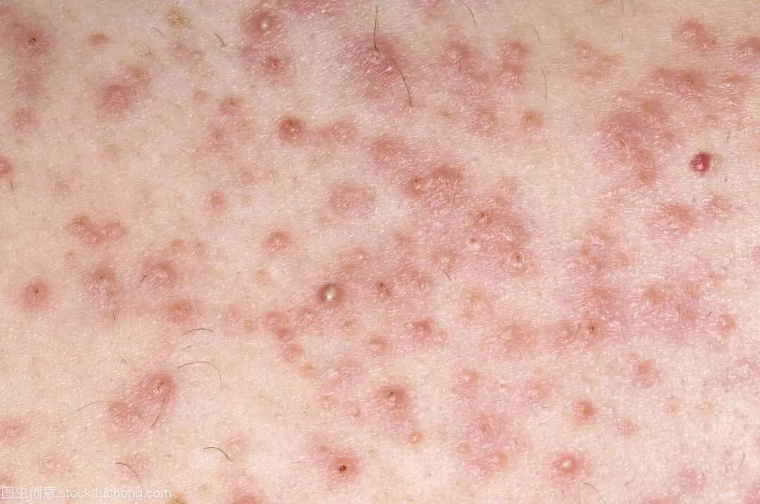 花几千块钱去美容院治痘会好吗,花了数万元购买医美项目