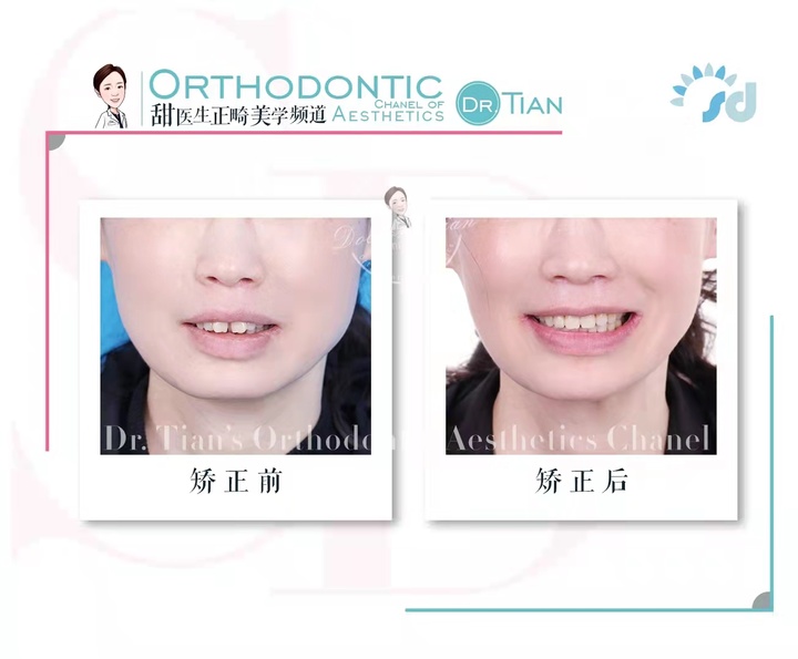 47岁大龄矫正,骨性嘴突+牙缝大+牙周炎|曹博士正畸复杂病例分享