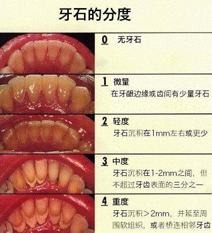 牙齿发黄还有牙菌斑怎么办,牙齿发黄有黑污怎么刷