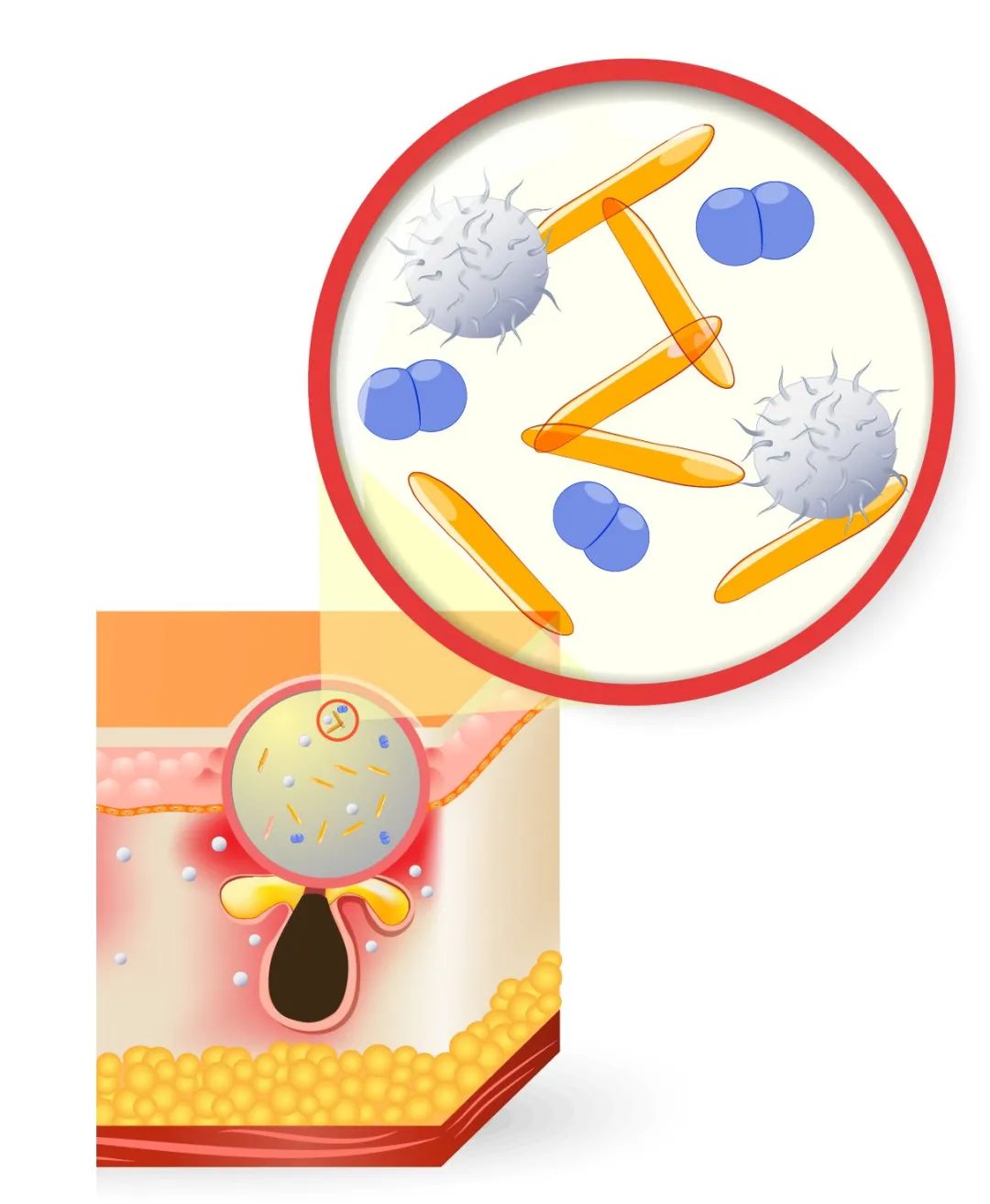 大学生挤痘痘引发的惨剧,女生挤痘痘导致面部感染