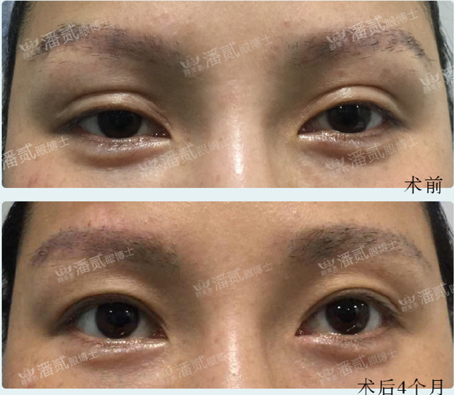 双眼皮修复有失败的吗,双眼皮修复失败了会怎样