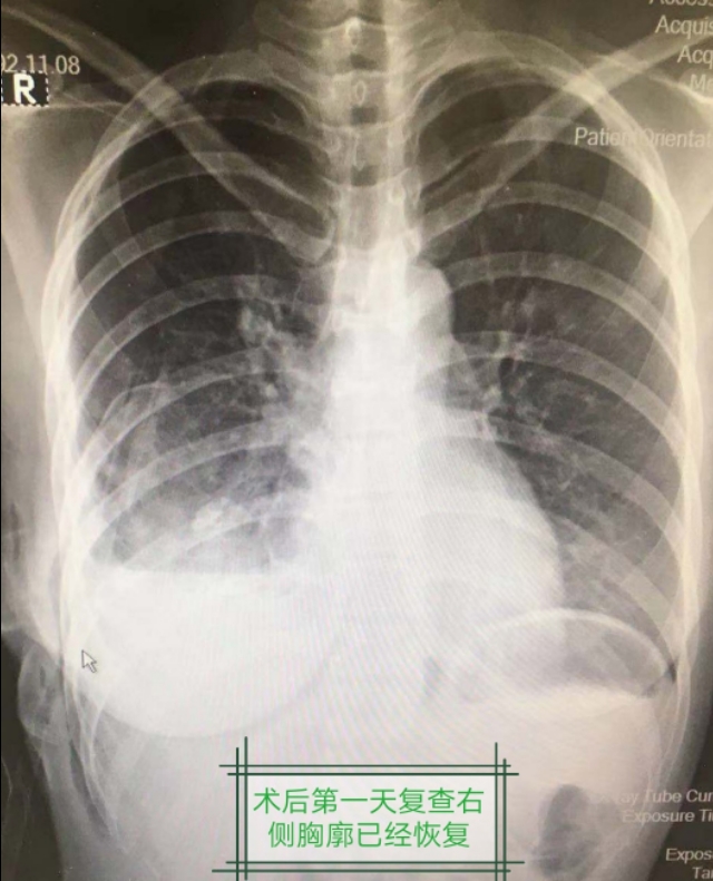 慢性脓胸手术费用报销,慢性脓胸哪里治得好