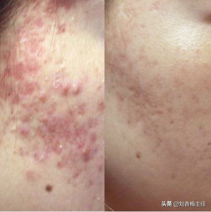 面部痘痘修复消炎,面部痘痘治疗的最佳方法