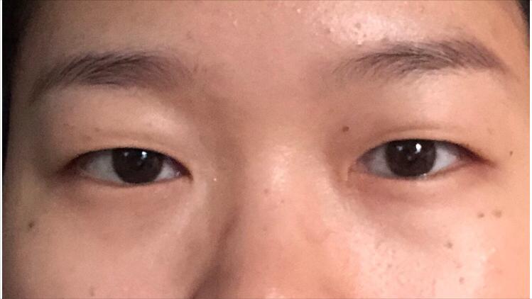 做双眼皮花了15000贵了吗,做个双眼皮手术30000块钱贵吗