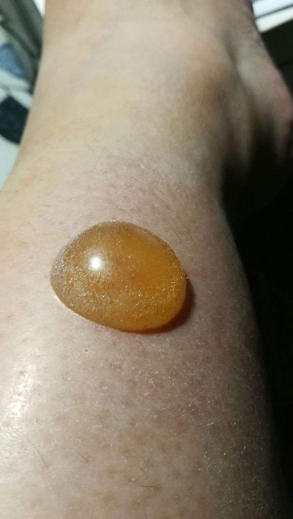 贴敷膏药的不良反应,贴敷疗法要注意什么