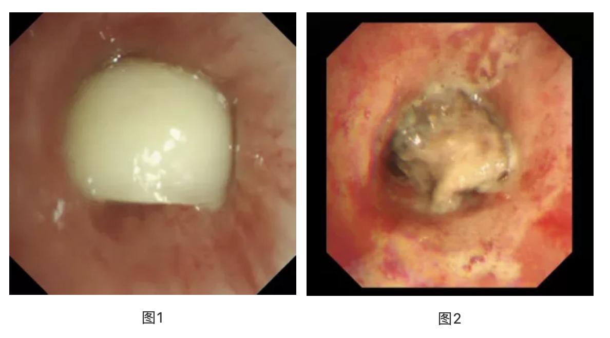 气管呛入异物最佳处理方法,呛住气管异物怎么自救