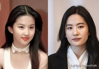 小切口除皱视频教程,小切口除皱术的优势有哪些