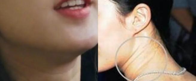 嗨体颈纹针使用方法,嗨体颈纹注射全过程