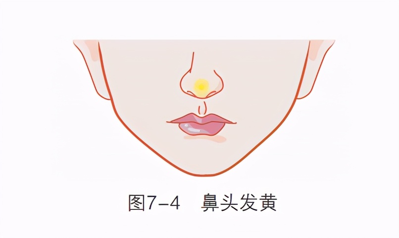 鼻子没嗅觉是梅毒引起的吗,鼻子出现梅毒症状