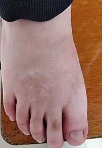 白癜风是个什么,白癜风到底是什么