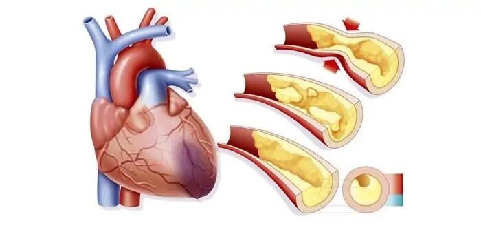 高血压发病机制公认的有哪些,高血压合并心肌梗死首选降压药