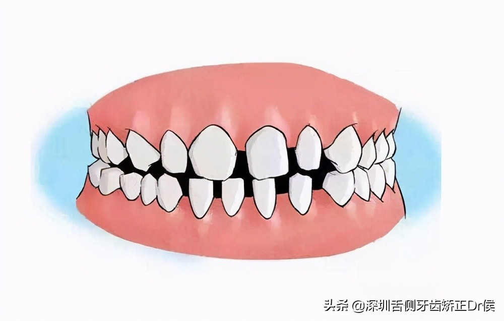 牙齿中间有黑色缝隙,牙齿有缝隙需要补吗