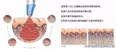 btl溶脂刀效果怎么样,btl射频溶脂刀有效果吗