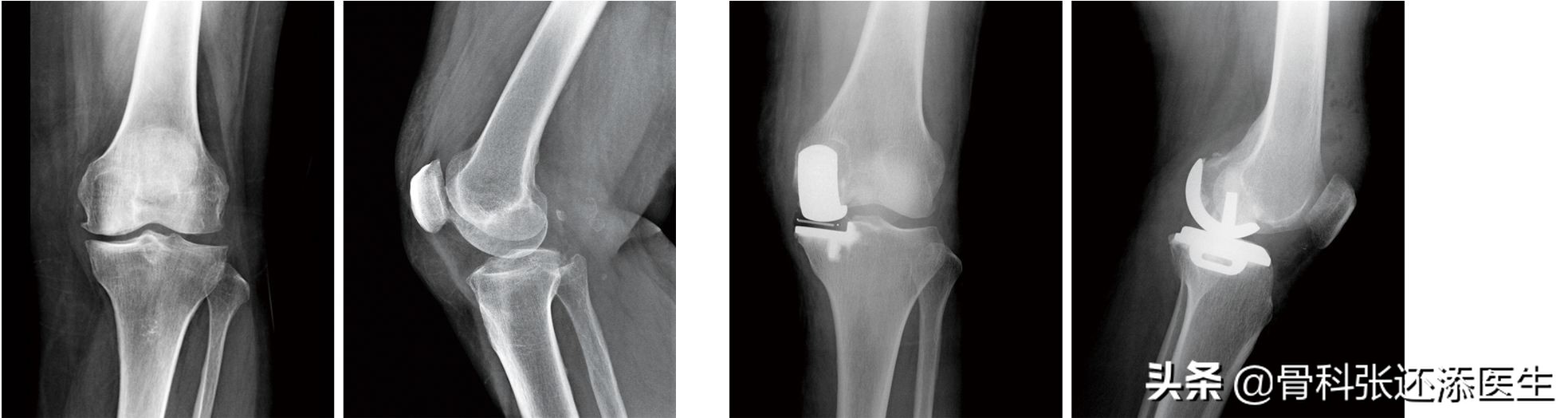 膝骨关节炎减轻疼痛的方法,膝盖骨关节炎怎么治疗效果最好