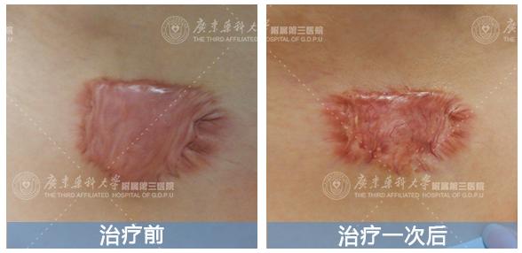 疤痕治疗能恢复原样吗,疤痕治疗了2年了还是红痒
