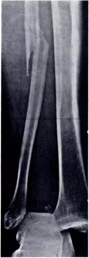 所有骨折都叫什么名字,骨折的名称有哪些