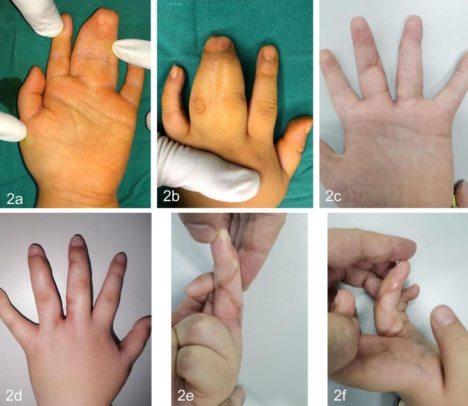 先天性并指畸形科普以及案例分享,先天性并指畸形