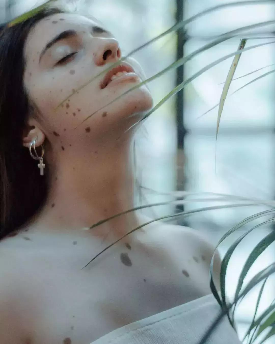 全身黑斑被骂“斑点狗”，身高160的她却成为最美超模…