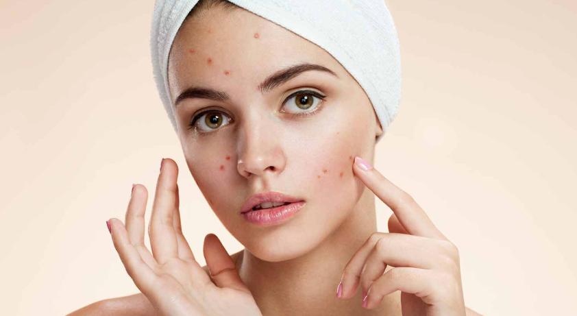 长痘痘为什么不能吃甜食,长痘痘饮食需要注意哪些