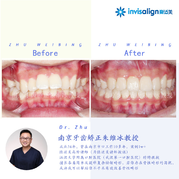 口腔正畸隐适美隐形矫治技术,隐适美深覆合矫正